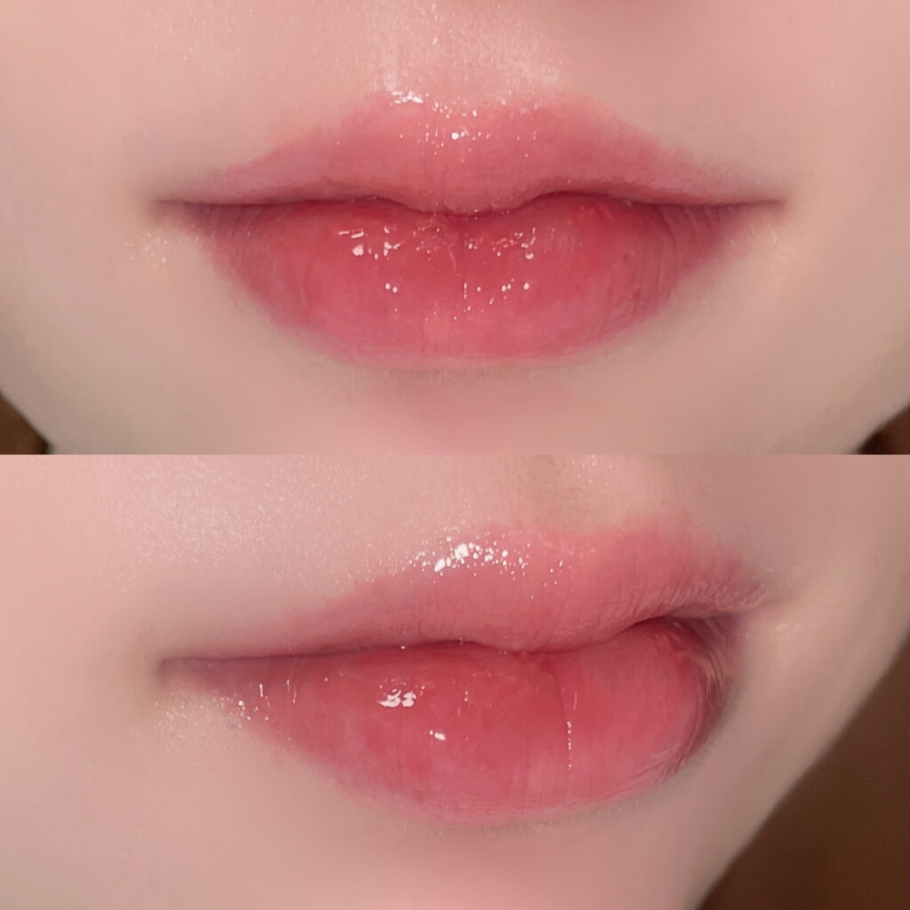 リップフィラー完成