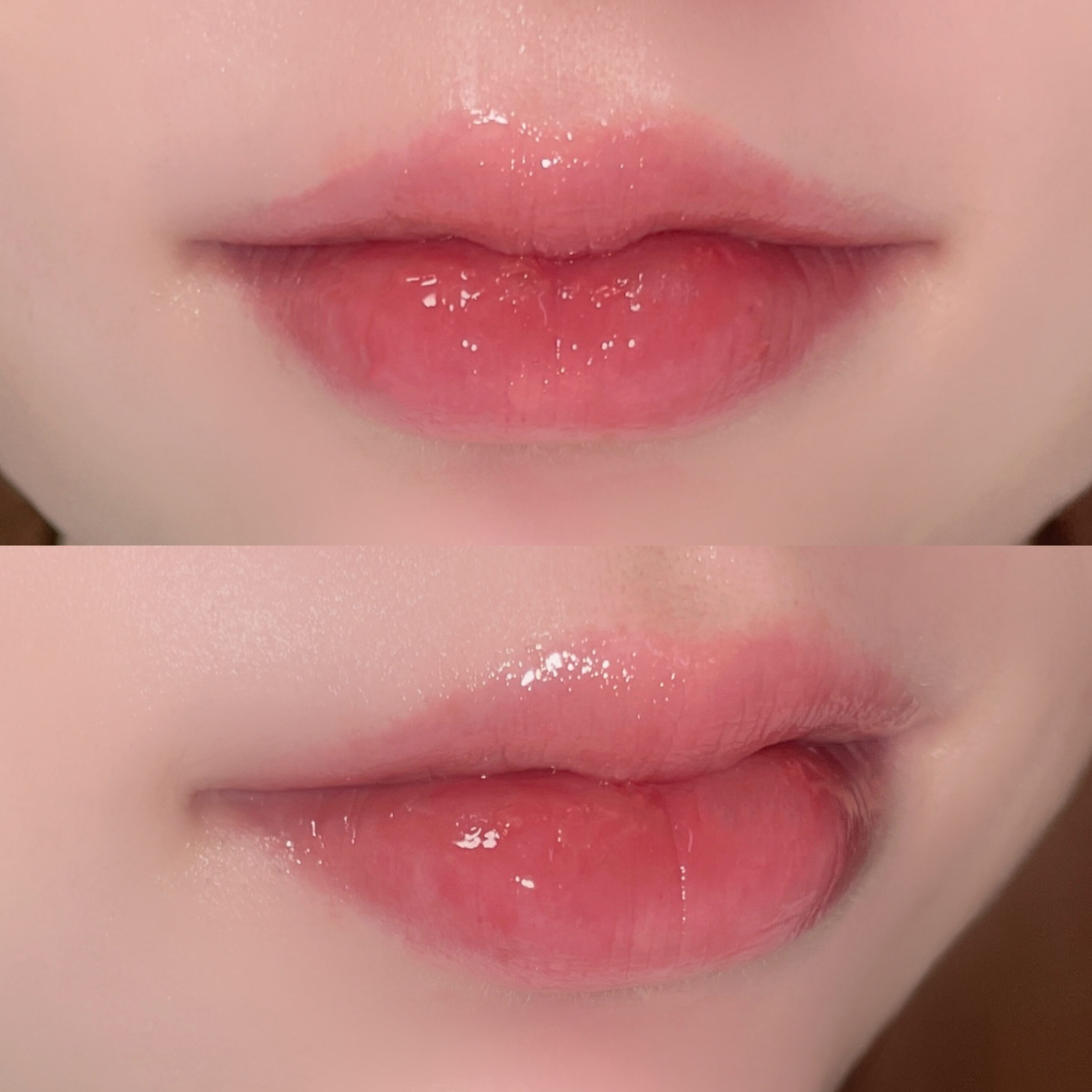 リップフィラー完成