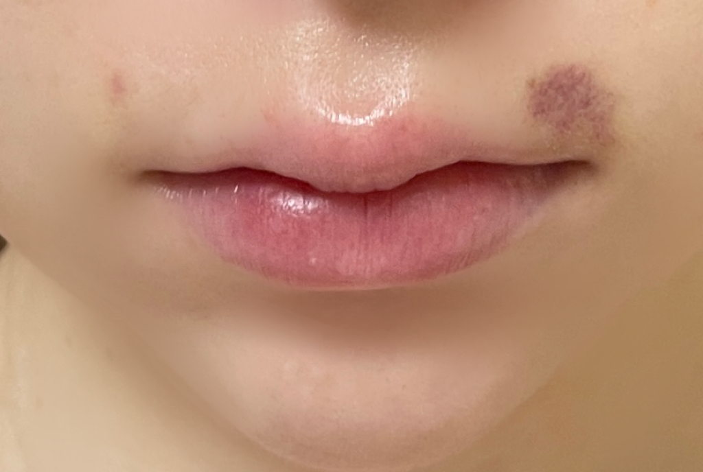 リップフィラーダウンタイム