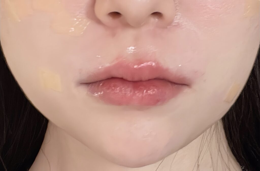 リップフィラー施術直後