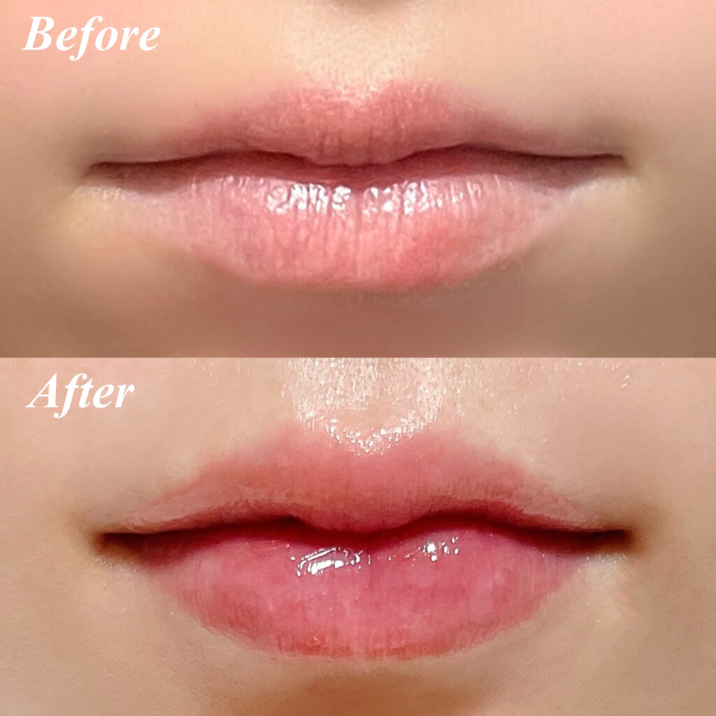 リップフィラービフォーアフター