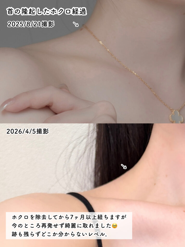 首のホクロ除去 経過