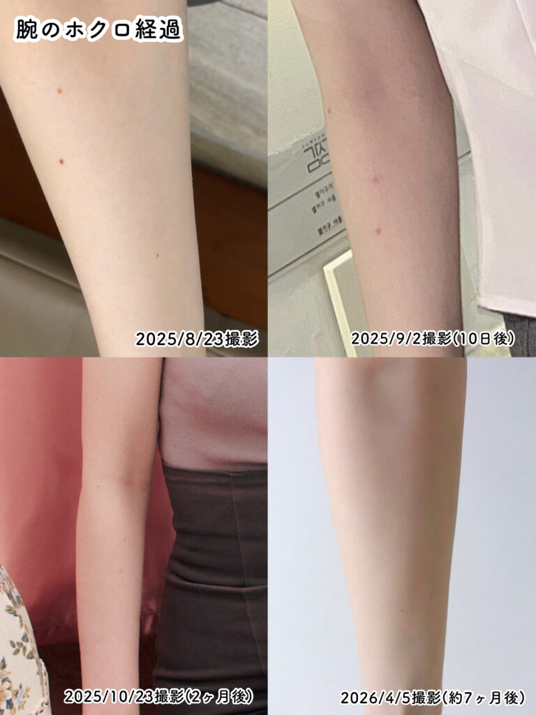 腕のホクロとり経過