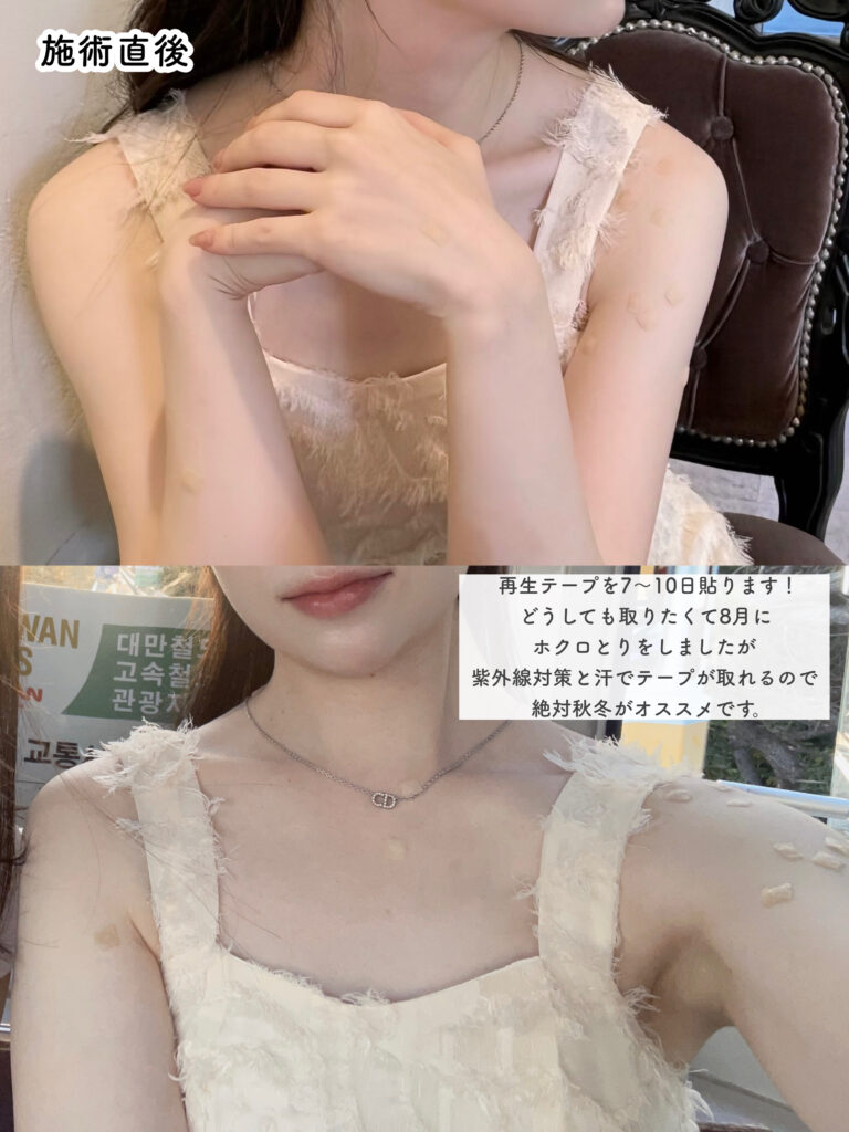 ホクロ除去 再生テープ